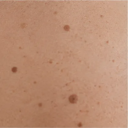 Symbolbild: Haut mit Pigmentmalen und Muttermalen bei der dermatologischen Beurteilung vor der Laserbehandlung in Rostock
