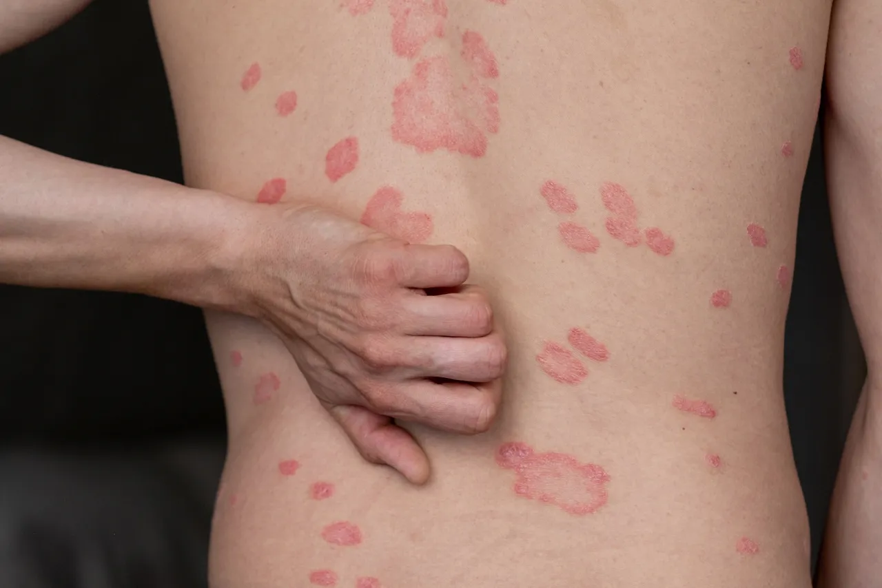 Symbolbild: Hauterkrankungen behandeln in Rostock: Psoriasis-Herde am Rücken eines Patienten