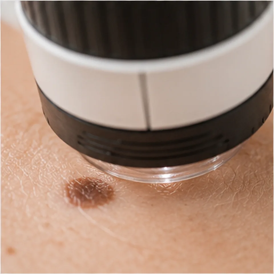 Symbolbild: Hautkrebsarten erkennen in Rostock: Dermatoskop über einem Muttermal beim Hautkrebsscreening