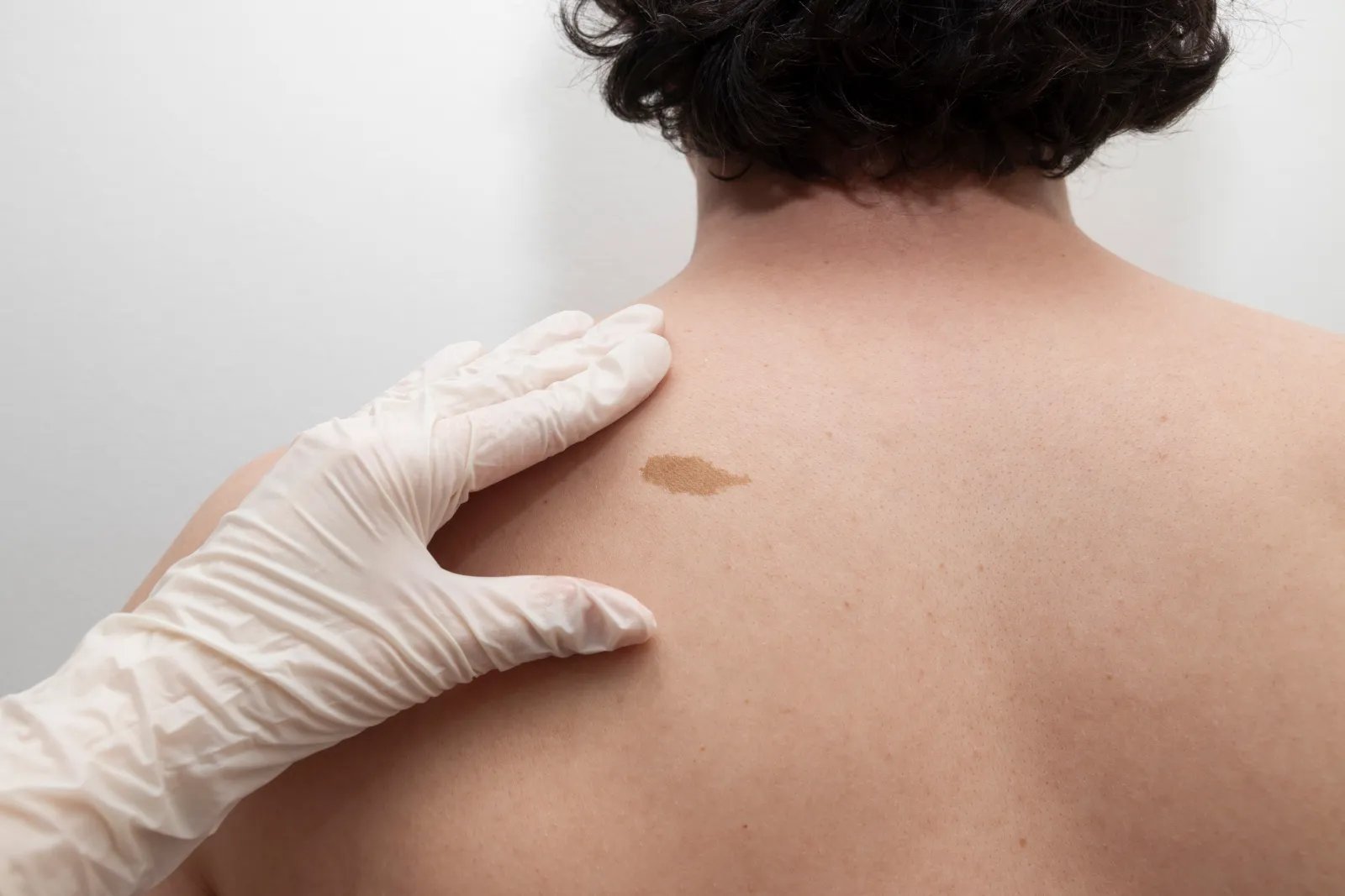 Symbolbild: Muttermal entfernen in Rostock: dermatologische Untersuchung eines Muttermals am Rücken beim Facharzt Dr. Dr. Ole Jung